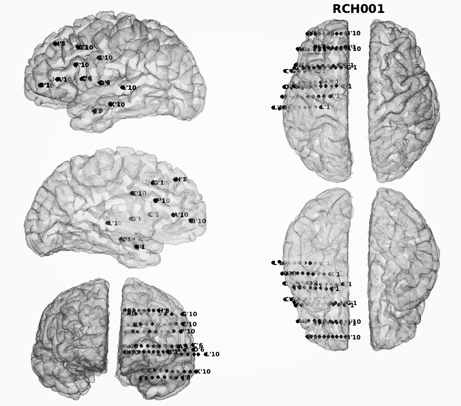 rch-implant.jpg